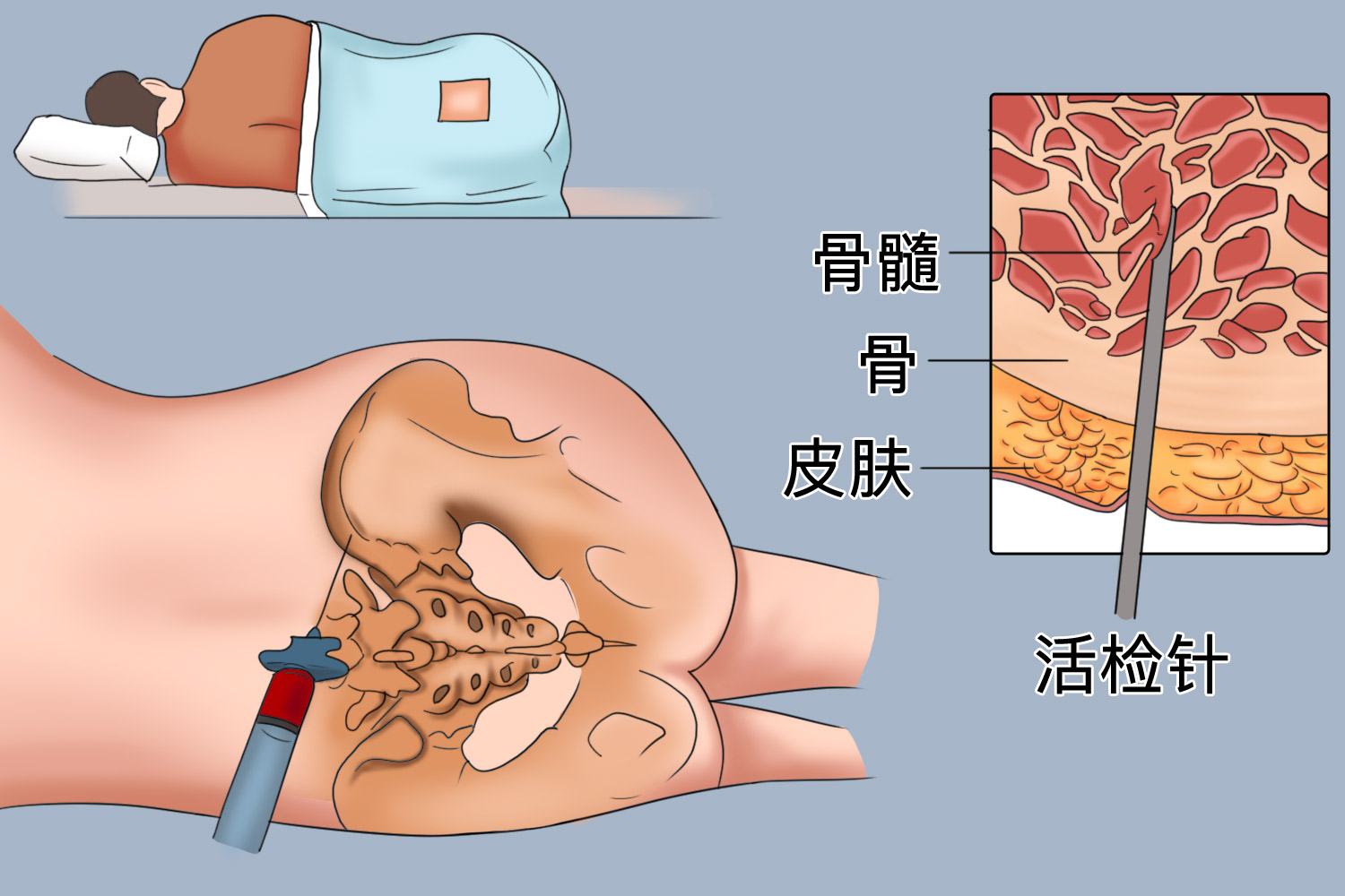 骨穿定位示意图图片