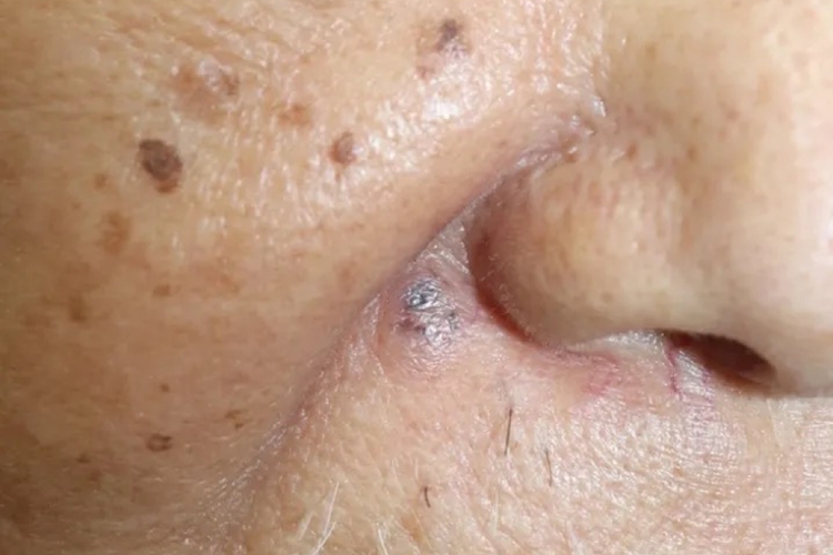 基底细胞癌早期图 基底细胞癌早期图