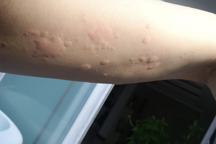 石棉过敏胳膊荨麻疹图