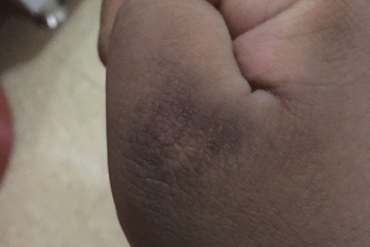 炎症后黑变病图