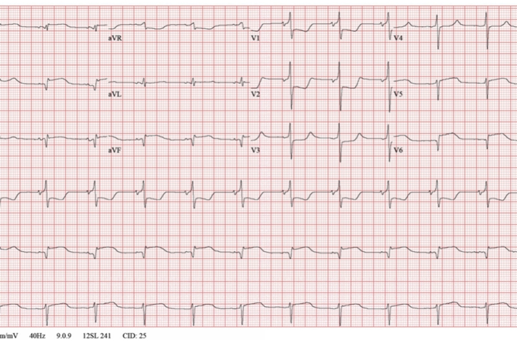 前壁心肌梗死心电图