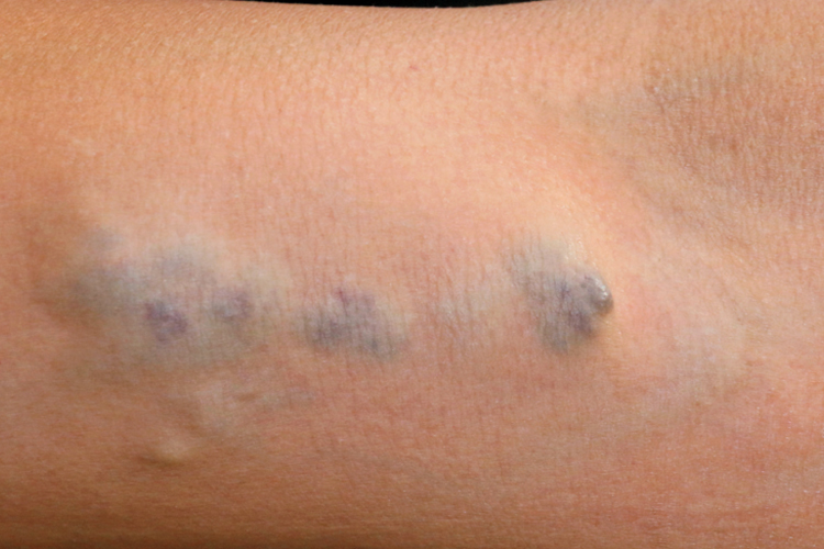 胳膊静脉畸形血管鼓包图