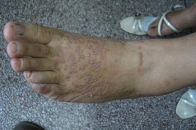 扁平疣样职业性疣赘脚背症状图