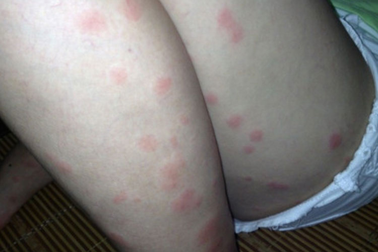 臭虫叮咬后风团样丘疹图 臭虫叮咬后风团样丘疹图