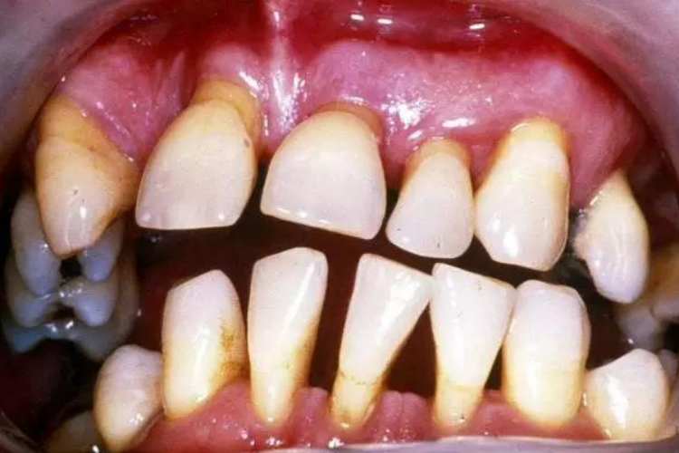 逆行性牙髓炎图