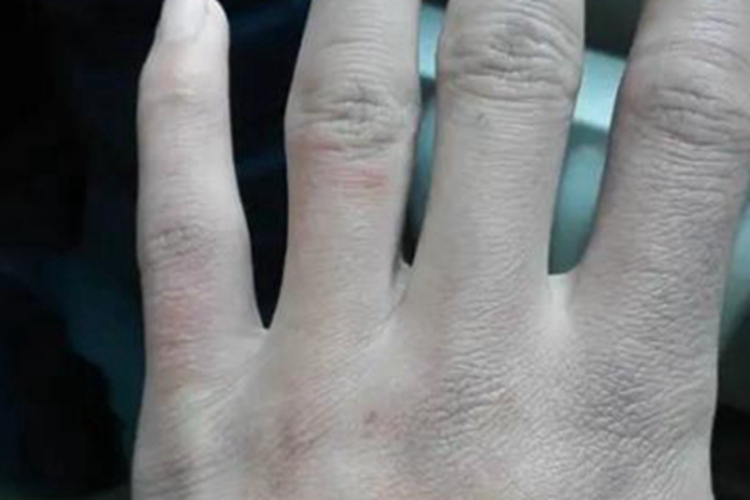 Ⅰ度冻伤手指症状图