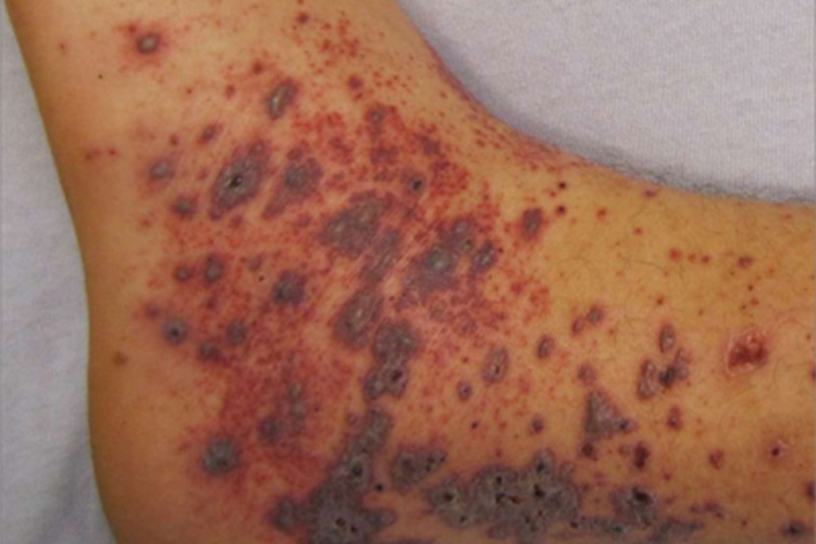 暴发性紫癜焦痂图