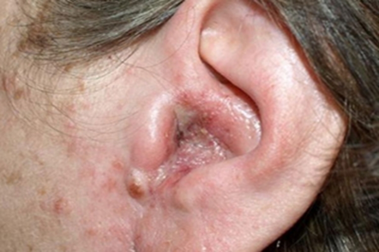 外耳湿疹耳朵里发红有黏液图 外耳湿疹耳朵里发红有黏液图