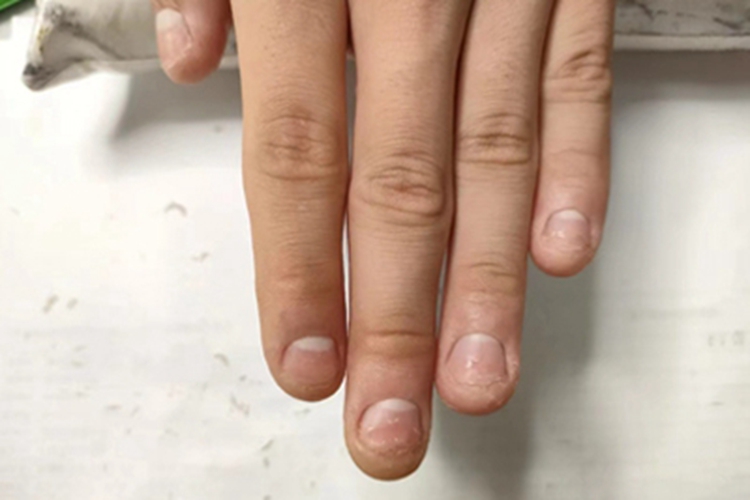 甲萎缩手指甲短小图