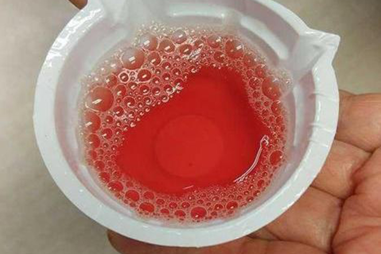 肾功能不好导致血尿图