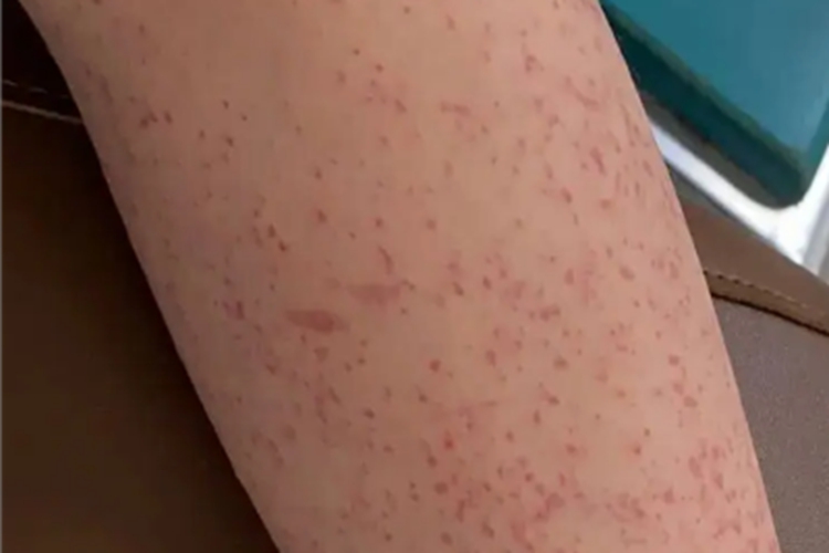 血小板减少性紫癜胳膊红点图