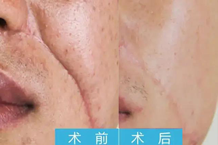 手术疤痕激光修复对比图