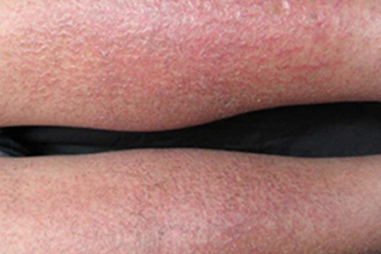 亚急性湿疹小腿小疙瘩图