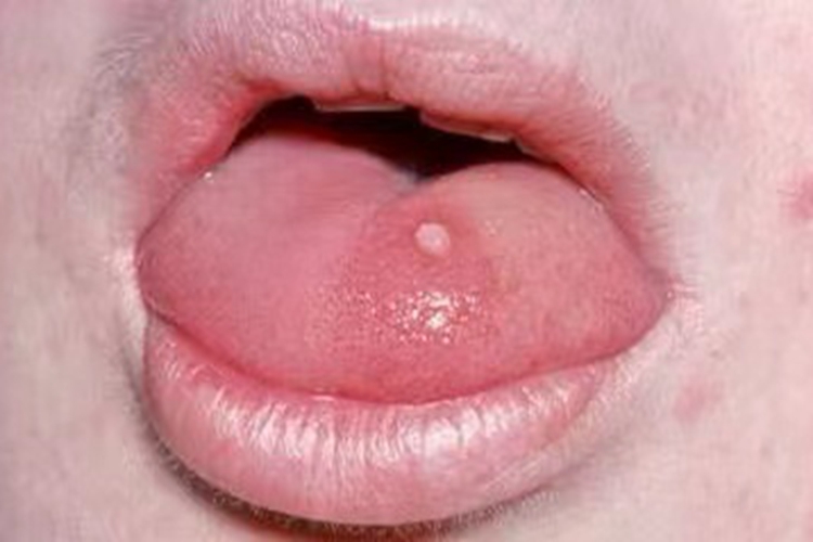 舌背面尖锐湿疣图