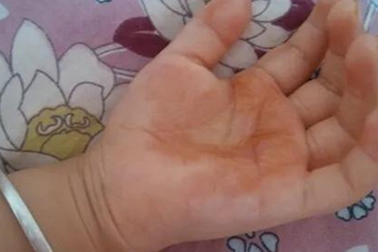 一度烫伤手掌皮肤发红图 一度烫伤手掌皮肤发红图