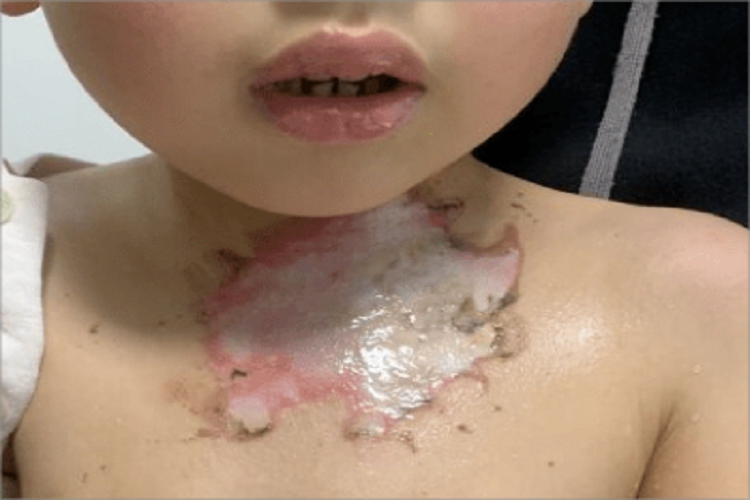 深Ⅱ度烧伤颈部脱皮图 深Ⅱ度烧伤颈部脱皮图