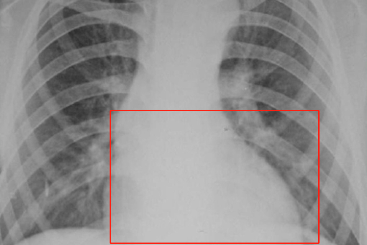 马方综合征X线检查靴型心图 马方综合征X线检查靴型心图