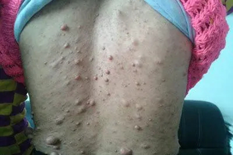 浅表性皮肤脂肪瘤痣背部症状图 浅表性皮肤脂肪瘤痣背部症状图