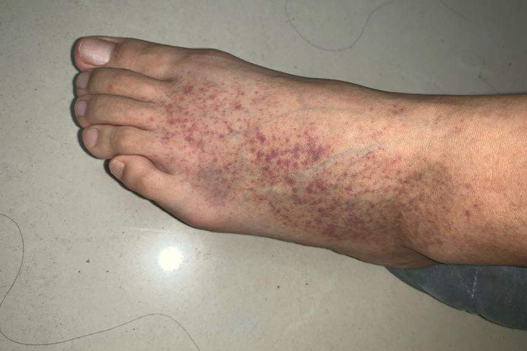 脚部过敏性紫癜淤血图