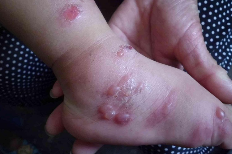 急性网状淋巴管炎脚背水疱图