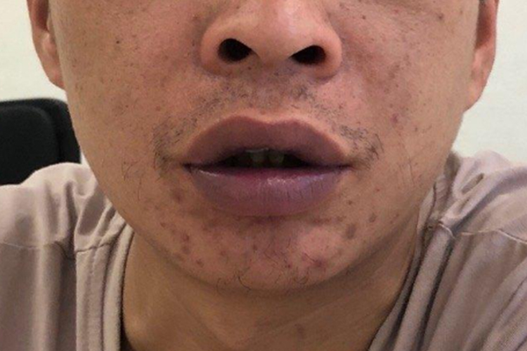 肺动脉高压蓝嘴唇图 肺动脉高压蓝嘴唇图