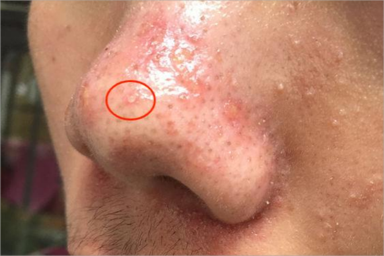 丘疹脓疱型酒糟鼻鼻尖脓包图