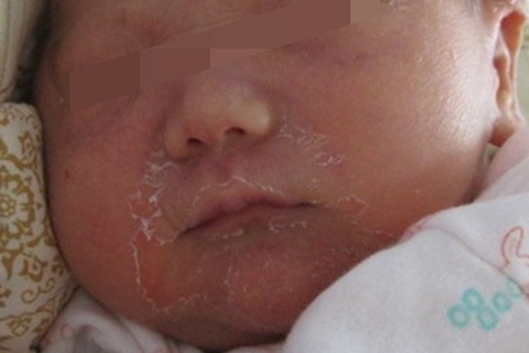 非大疱性鱼鳞病样红皮病脱屑图 非大疱性鱼鳞病样红皮病脱屑图