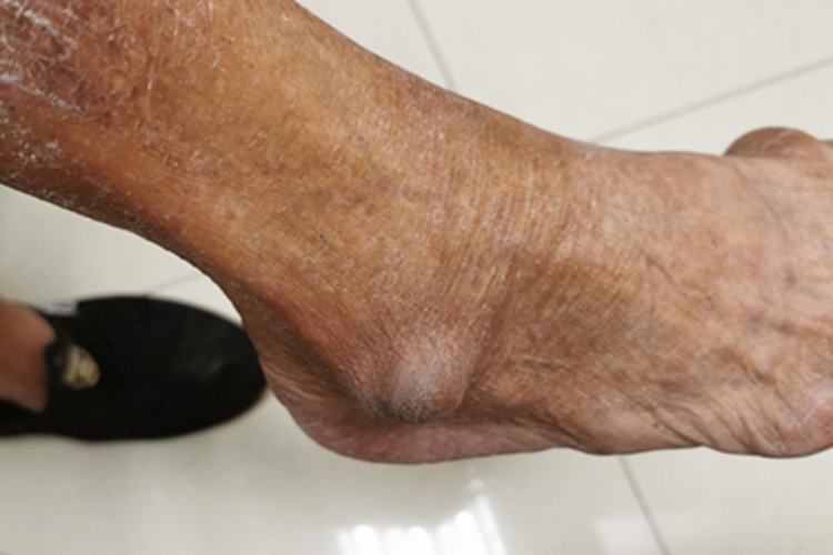 痛风脚踝症状图 痛风脚踝症状图