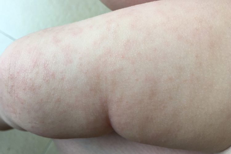 宝宝腿上痱子图