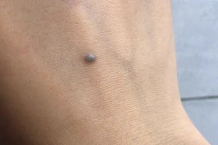 皮内痣手背症状图