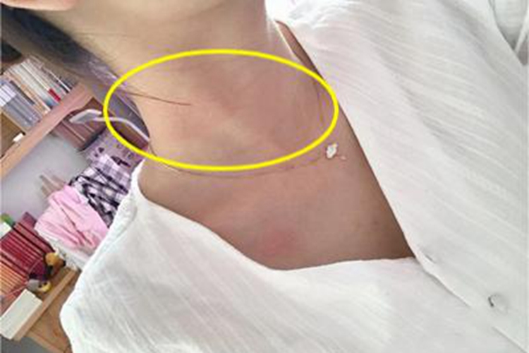 荨麻疹颈部红斑图