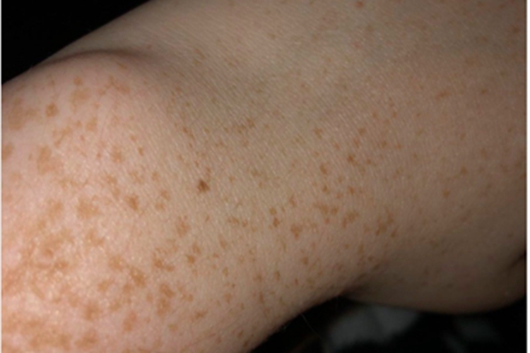 网状肢端色素沉着斑图