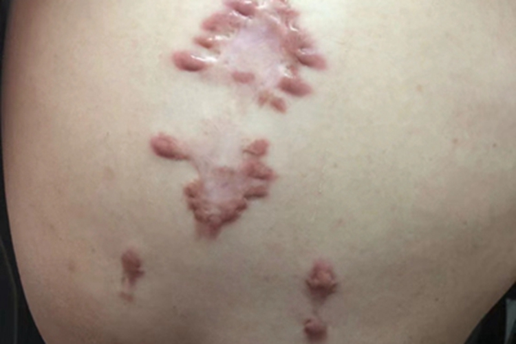 瘢痕疙瘩上腹疙瘩图 瘢痕疙瘩上腹疙瘩图