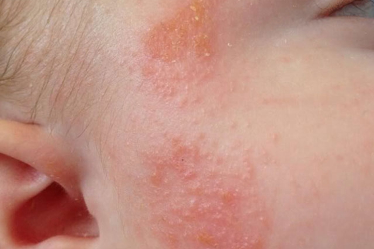脸部急性湿疹丘疹图