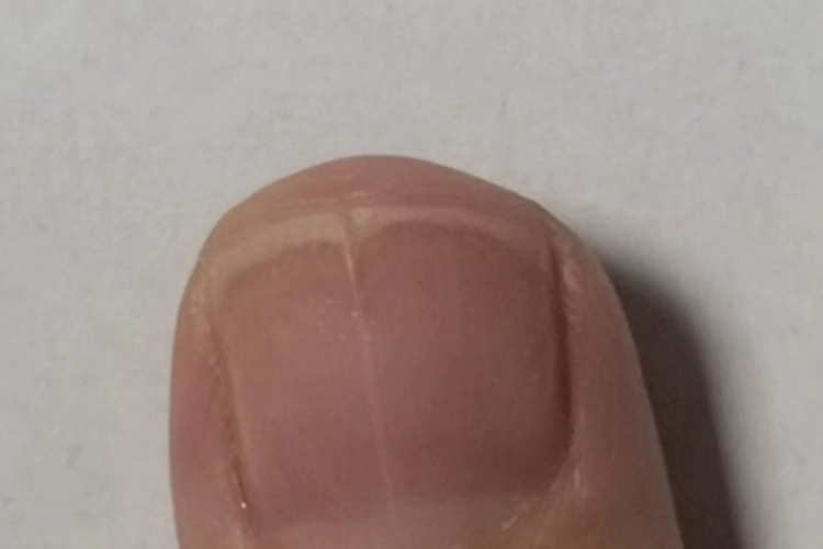 甲纵裂指甲有一条裂纹图