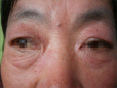 混合性结缔组织病的症状和图片 - 有来医生