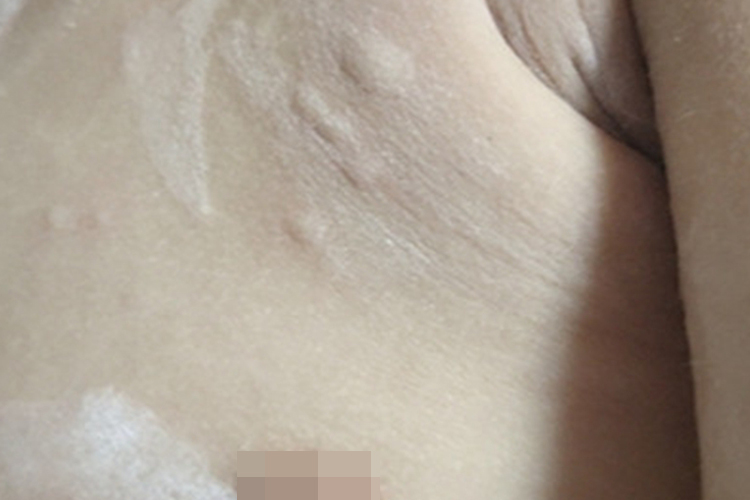 荨麻疹胸部疙瘩图（需打码）