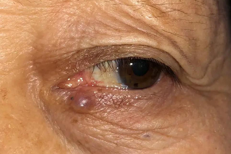 眼睑基底细胞癌初期图