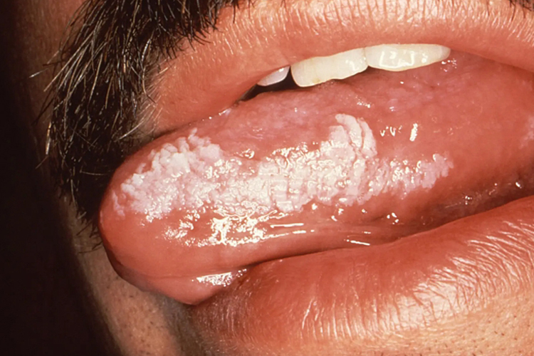 早期舌头白斑病图片图片