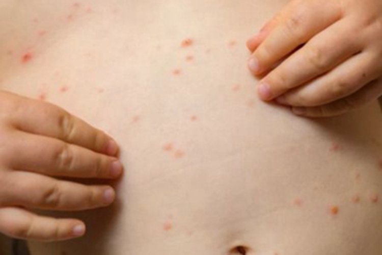 麻疹型药疹腹部丘疹图