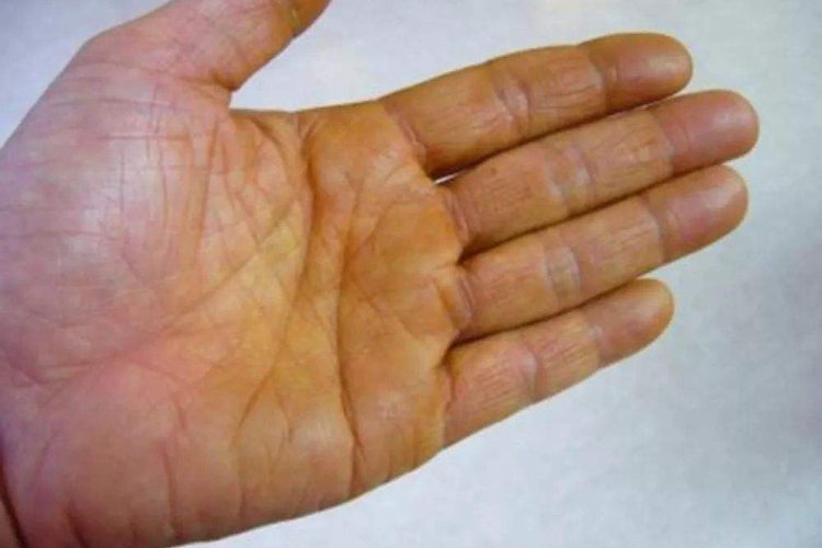 胆道梗阻手黄褐色图