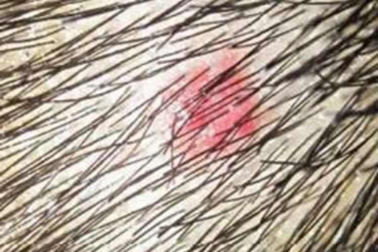 头虱病头皮疙瘩图