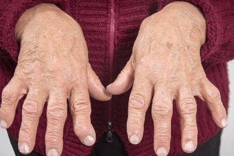 类风湿关节炎食指疼痛图