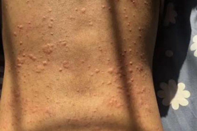 荨麻疹背部小疙瘩图 荨麻疹背部小疙瘩图