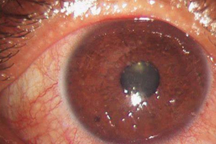 丝状角膜病变眼球小疙瘩充血图