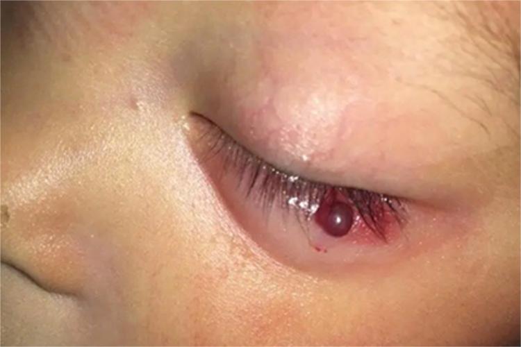 化脓性肉芽肿眼睑红肿图