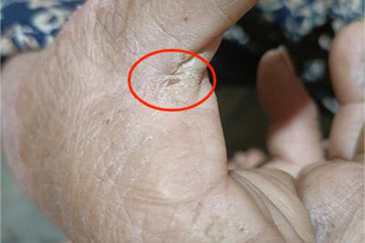 Ⅰ度皮肤皲裂结痂图