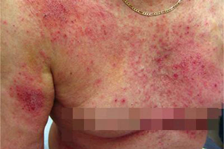 湿疹样紫癜胸部症状图 湿疹样紫癜胸部症状图