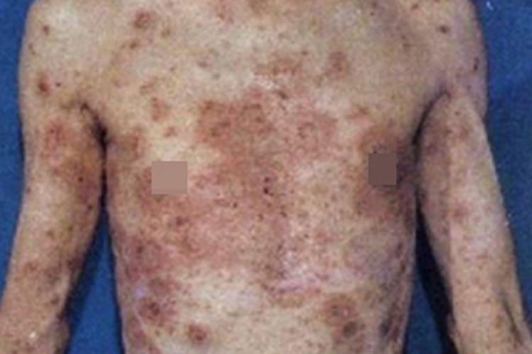 疱疹样皮炎腹部斑图 疱疹样皮炎腹部斑图