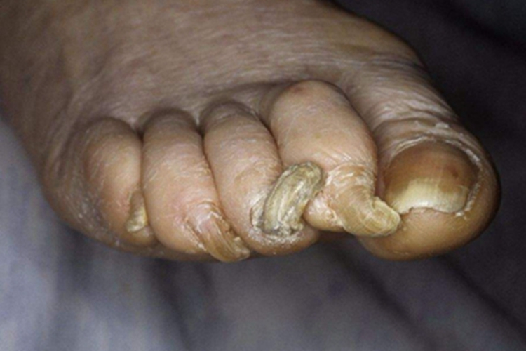 钩甲脚趾甲增厚弯曲图